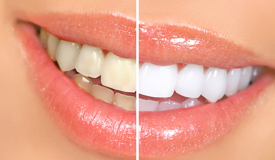 La clínica dental Dentalarroque mejorar tu estética dental con el blanqueamiento dental majadahonda. Tu sonrisa vuelva a brillar.