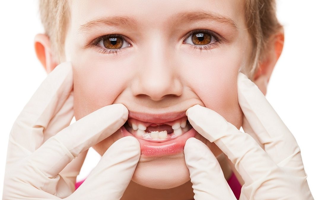 El odontopediatra en Dentalarroque ofrece consejos sobre los dientes de leche. Se debe acudir al dentista infantil desde el primer cumpleaños.