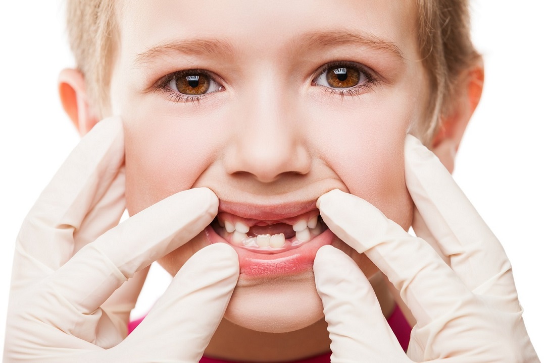 El odontopediatra en Dentalarroque ofrece consejos sobre los dientes de leche. Se debe acudir al dentista infantil desde el primer cumpleaños.
