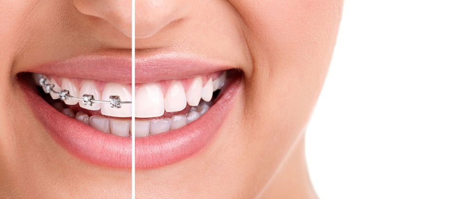 ¿Por qué elegir ortodoncia invisible? Invisalign es la mejor opción de alineación dental.
