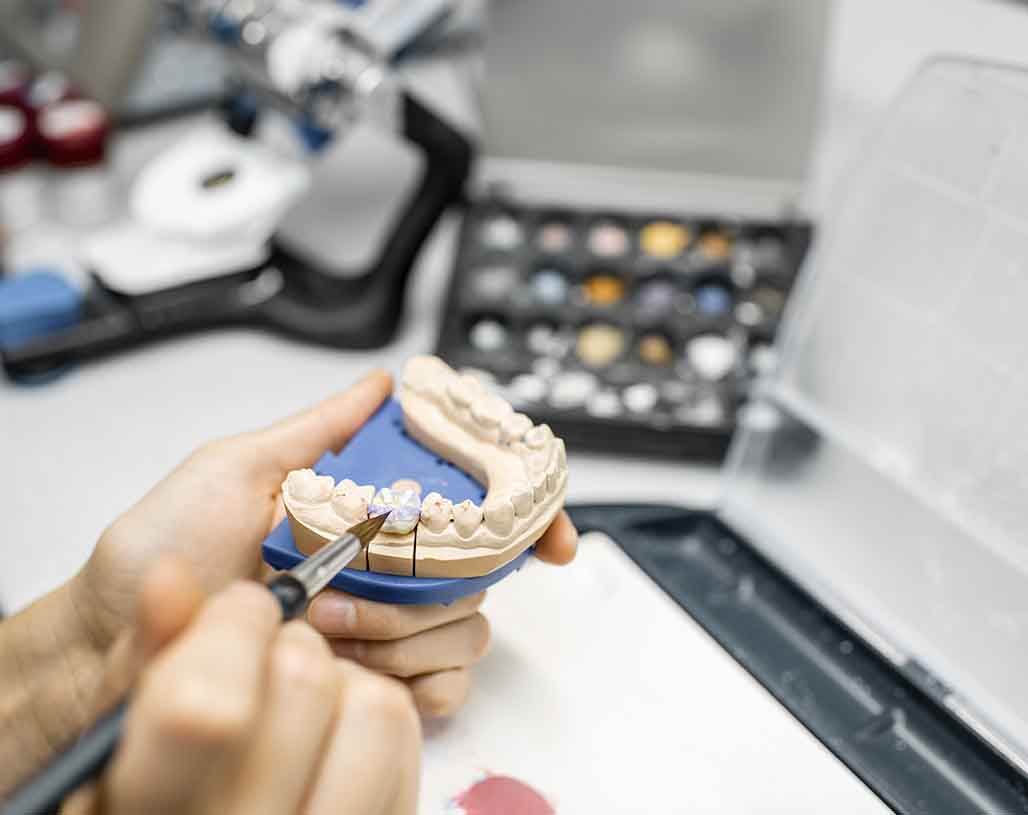 corona para implante dental