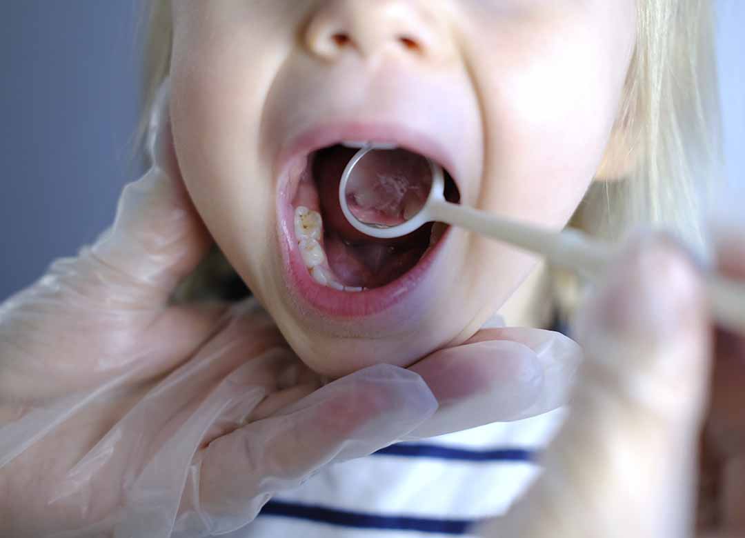 cuidado de la salud bucal infantil