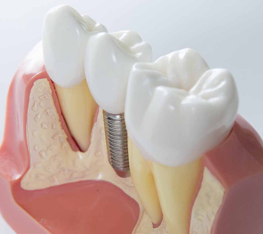 creacion protesis dental
