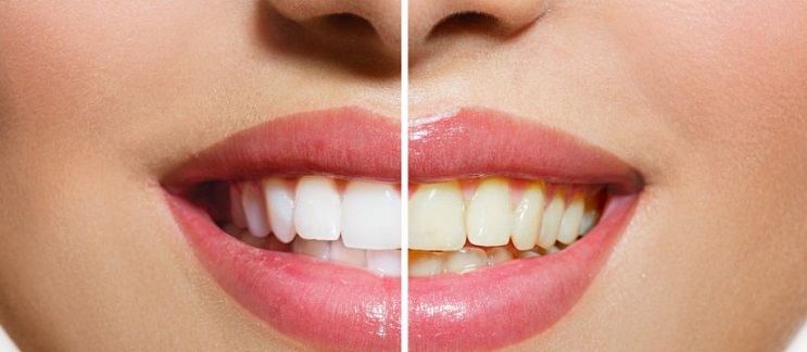 Una de las causas de los dientes amarillos es la alimentación. En Dentalarroque te ayudamos a cuidar de tu boca.