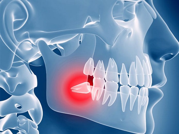 La clínica Dentalarroque recomienda quitar las muelas del juicio quitar las muelas para prevenir cualquier problema dental.